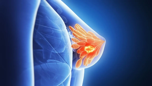 أخطر أنواع سرطان الثدي